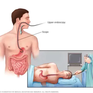 Upper endoscopy